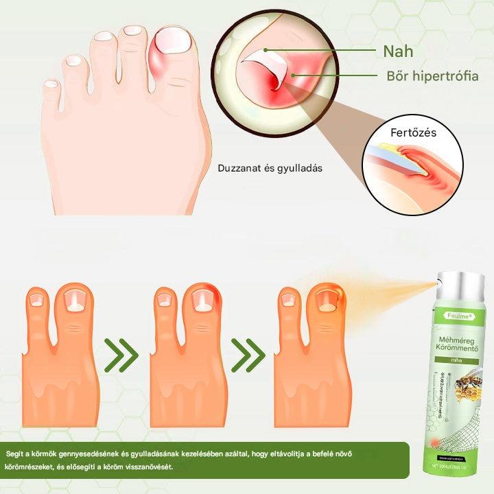 Korlátozott ideig 50%-os kedvezmény | Foulme® NailRescue Méhméreg Spray🐝